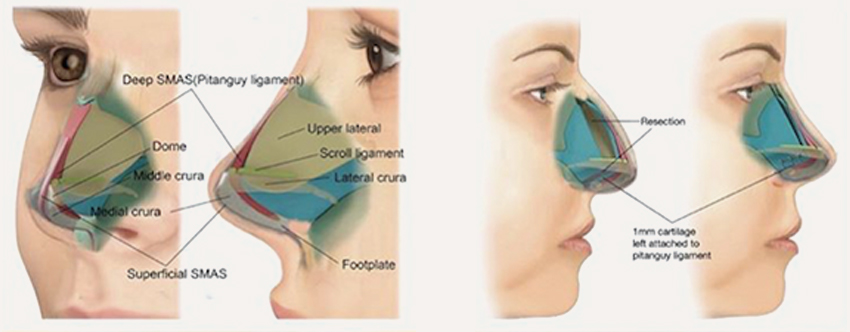 rhinoplasty-img-1